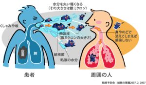 【結核】大阪市で40代男性が死亡、勤め先関係者ら14人集団感染…せき・たん出始め1年後に症状悪化