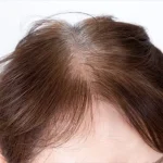【衝撃】ヘルシーに見えて､｢薄毛｣リスクが上昇…専門医が｢血流の大敵｣と名指しする日本人が大好きな”白い食べ物”とは