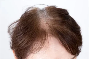 【衝撃】ヘルシーに見えて､｢薄毛｣リスクが上昇…専門医が｢血流の大敵｣と名指しする日本人が大好きな”白い食べ物”とは